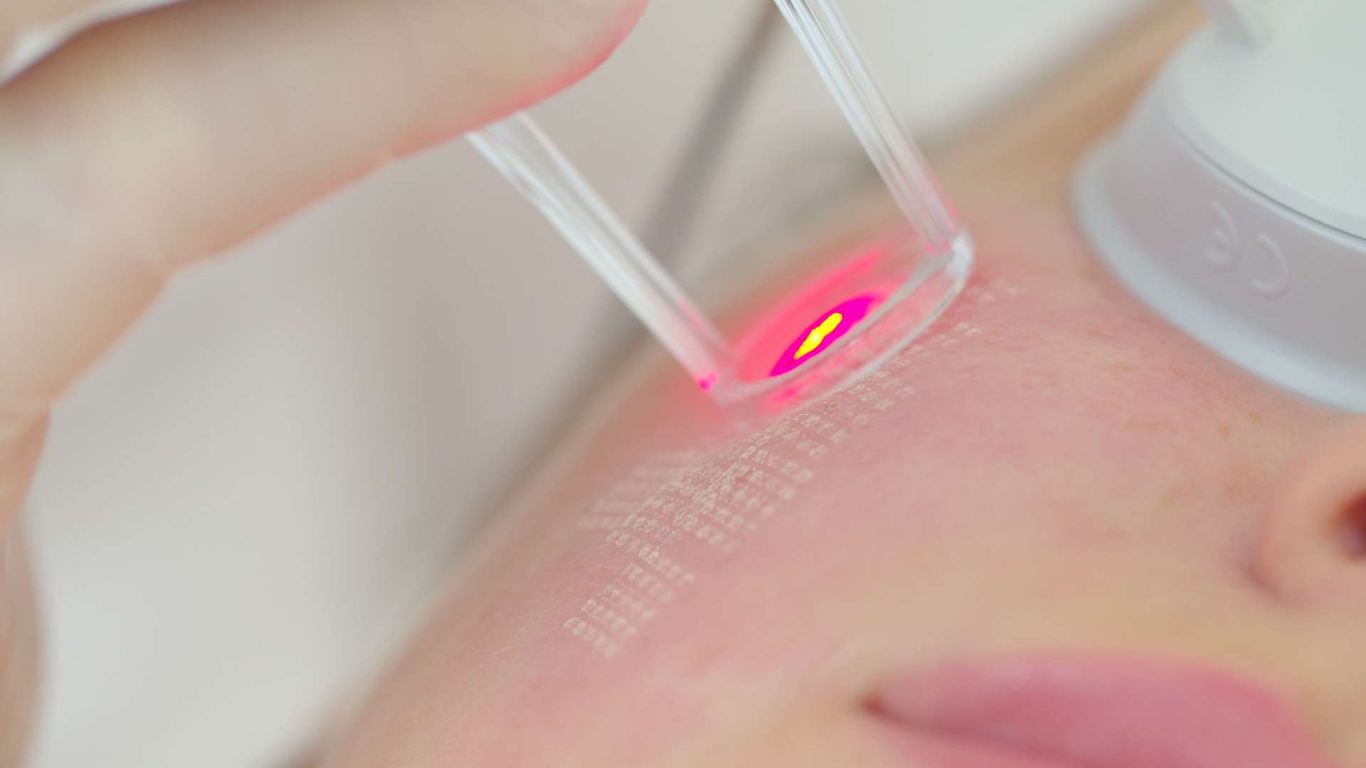 Understanding the Benefits of Fotona Laser Treatments