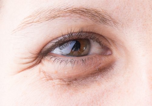 Dermal Fillers near Brasted Kent